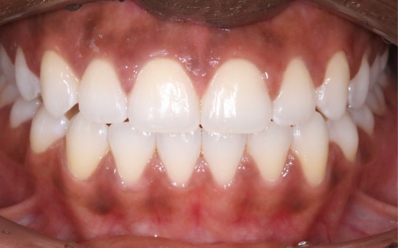 Orthodontic treatment results - After