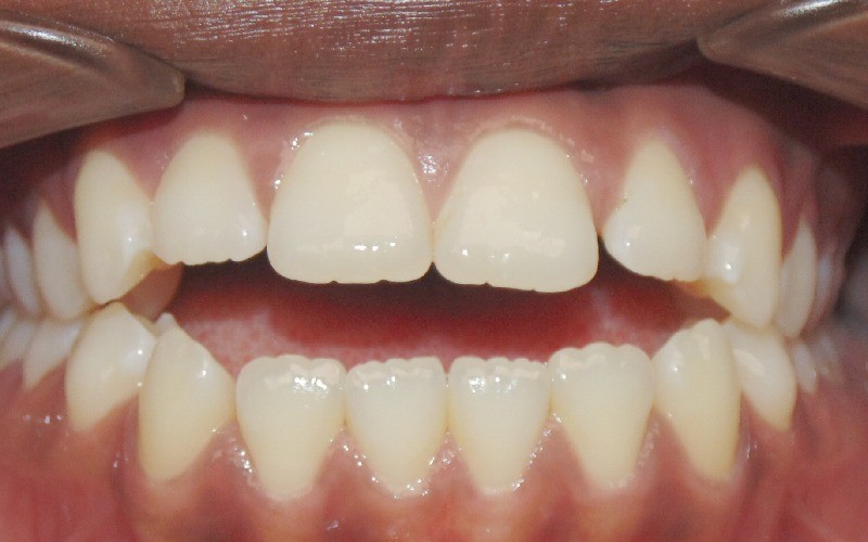 Orthodontic treatment results - Before