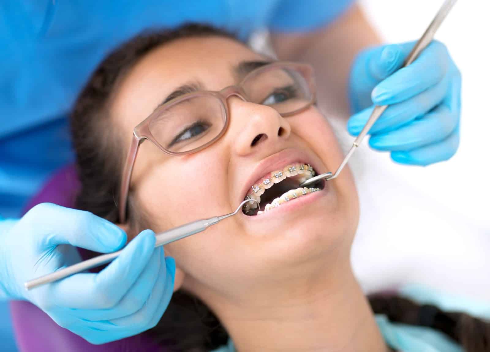 Why We Recommend Damon Braces
